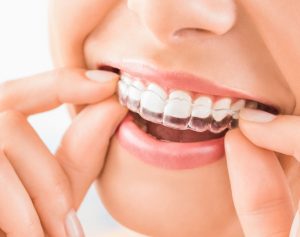 Remove Your Invisalign