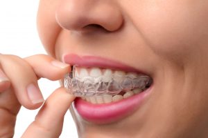 Tysons Dental Spa Clear Aligners