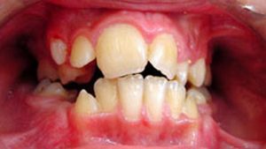 What Is Macrodontia?