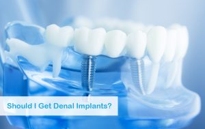 2020 07 Tysons Should I Get Dental Implants