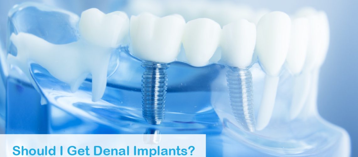 2020 07 Tysons Should I Get Dental Implants